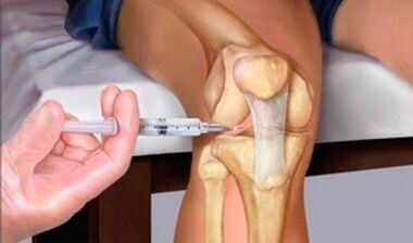 Hyaluronic acid with arthrosis of the knee joint