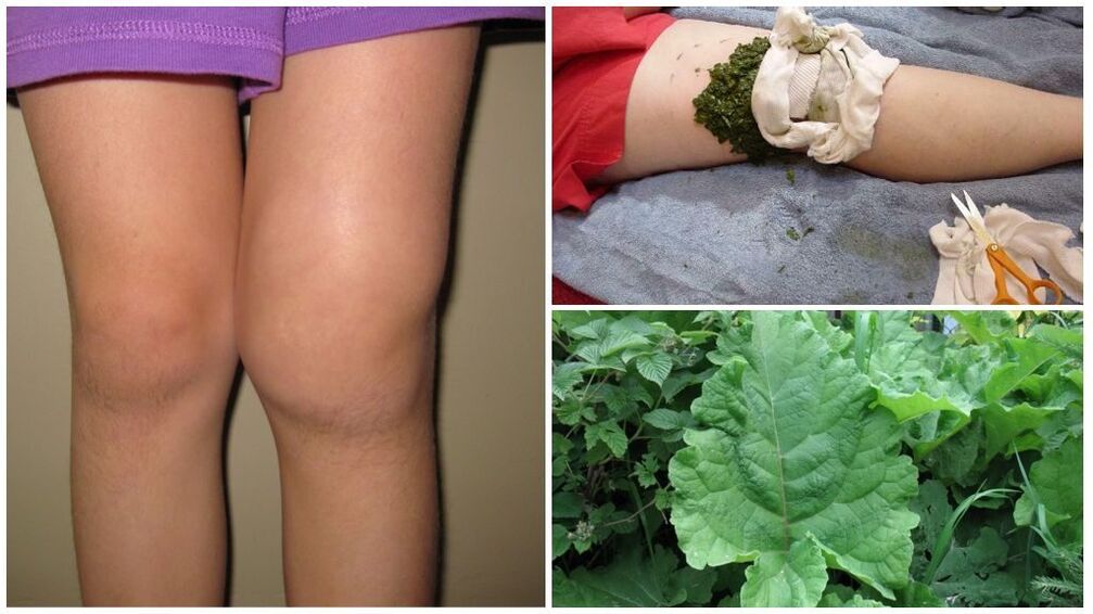 Compressing the knee with burdock is a popular method for treating gonarthrosis
