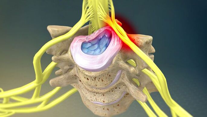 Protrusion of the intervertebral disc causes neck pain