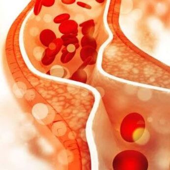 The deposition of cholesterol on the internal walls of the blood vessels causes pain in the lateral part of the neck